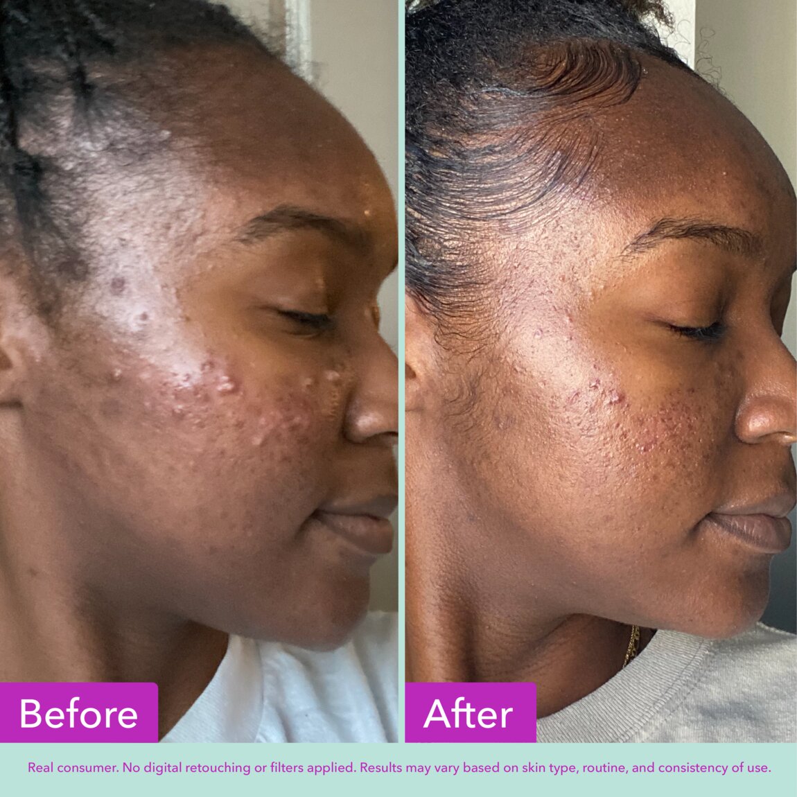 acne-foaming-cleanser-g7 zb_p.jpg